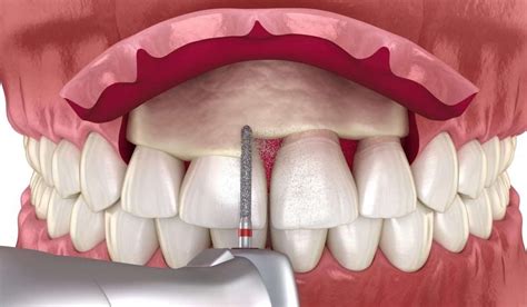 Hydroxyapatit: Die Wunderwaffe für Knochenersatz und Zahnimplantate!